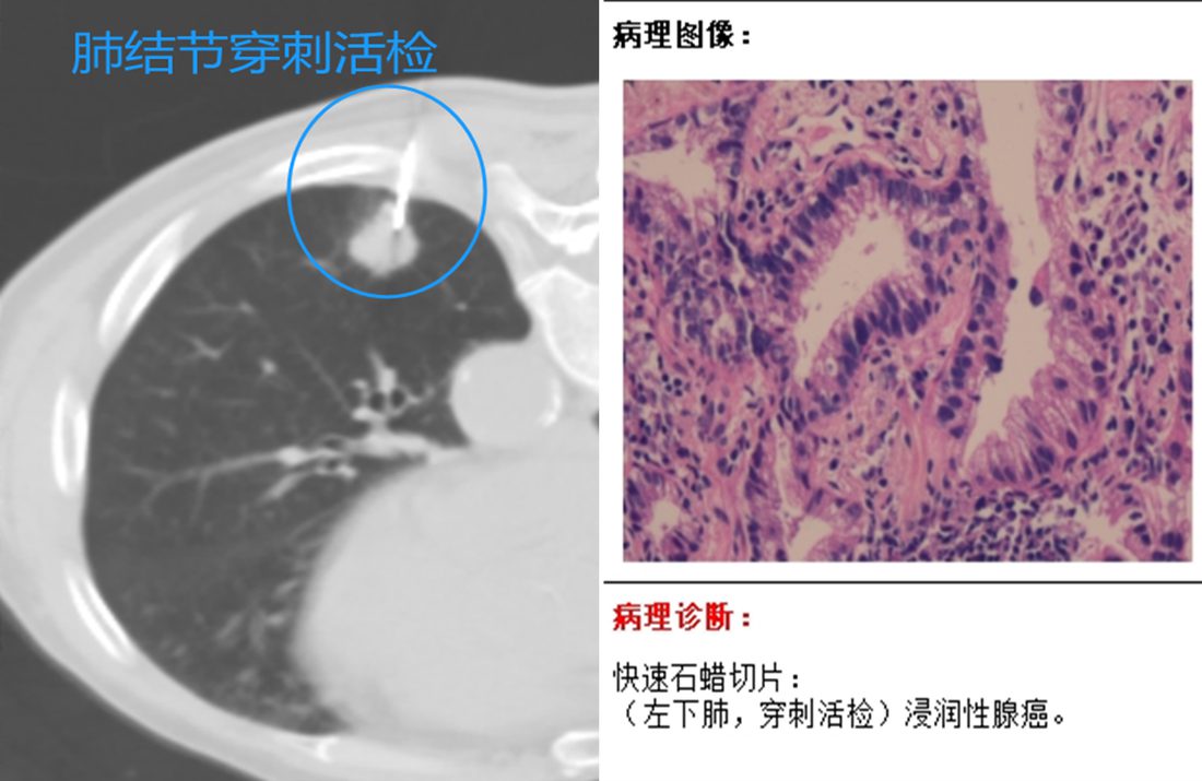 CT引导穿刺活检确诊