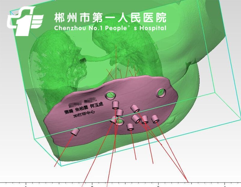 TPS+3D导板粒子植入